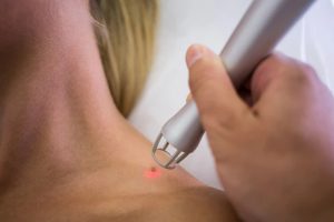 Mole Removal in UK - Electrocautery 