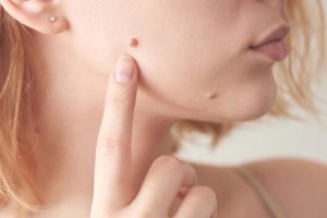 Mole Removal in UK 